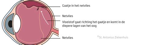 netvliesloslating